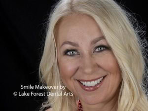 Best Porcelain Crowns Chicago