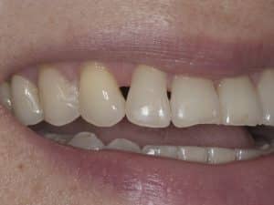 Lost gum from between teeth