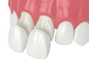 placing veneers