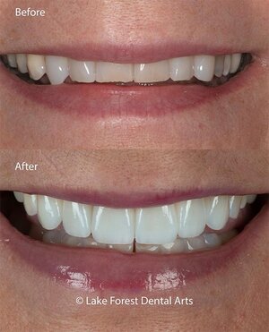 Veneers before and after teeth wearing down