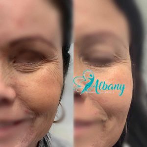 Botox for smile lines