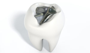 Replace metal fillings