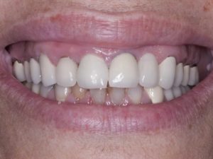 Patient requesting smile makeover Smile Makeover - before