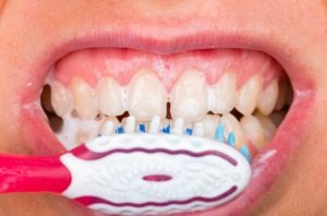 bleeding gums
