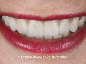 Life-like crowns as part of a full mouth makeover Teeth makeover