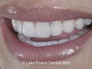 full mouth reconstruction