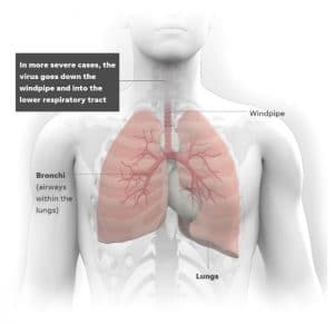 Syndromes in coronavirus affected in the at the human throat