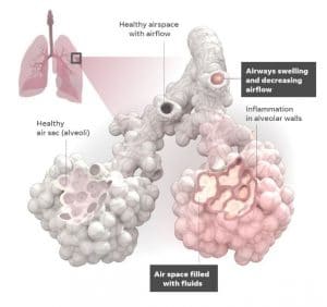 comparison between healthy and infected alveoli of human lunge