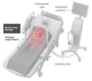 A person having support from mechanical ventilation due to severe lung damage or multiple organ failure