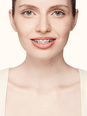 braces for all ages