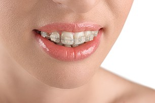Damon Braces Cost Orange County CA