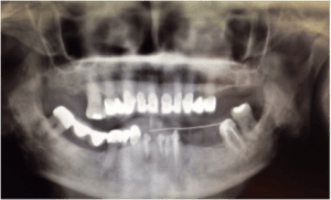 implants dentaires dentiste paris