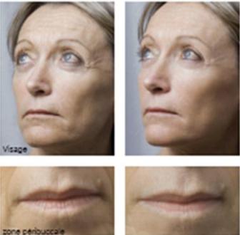 FILORGA ANTI-AGING MESOTHERAPY