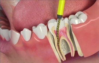 Best Root Canal Treatment in Gurgaon