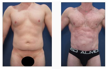 Chest sculpting for definition
