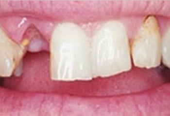 dental bridges dental bridges