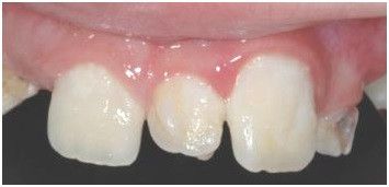 Extra teeth in Midline Extra teeth in Midline