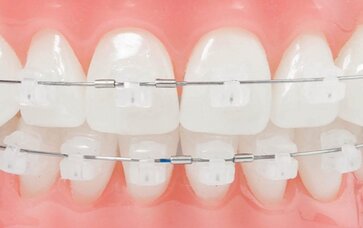 Braces Cost in Gurgaon