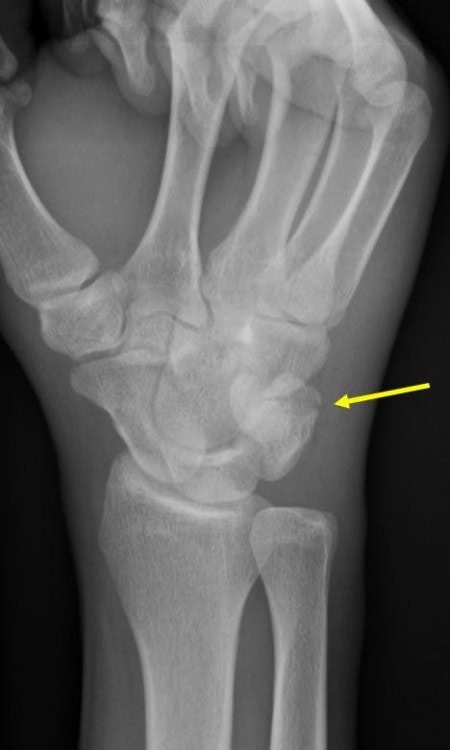 Resolution of 28-year-old Boxer with Wrist Pain
