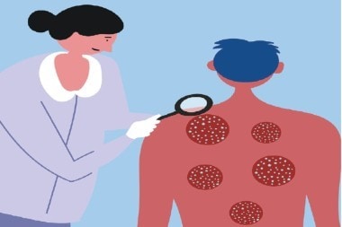 Guttate Psoriasis: An Uncommon Cause of a Rash Guttate Psoriasis: An Uncommon Cause of a Rash