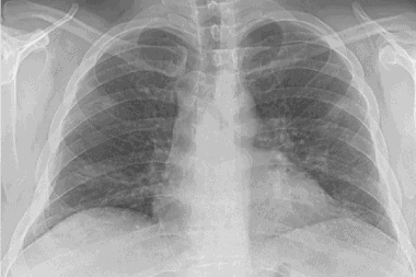A 40-Year-Old Man with Cough and Fever During the COVID-19 Pandemic A 40-Year-Old Man with Cough and Fever During the COVID-19 Pandemic