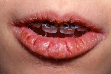 A 13-Year-Old Girl with Scaling and Fissures on Her Lips A 13-Year-Old Girl with Scaling and Fissures on Her Lips