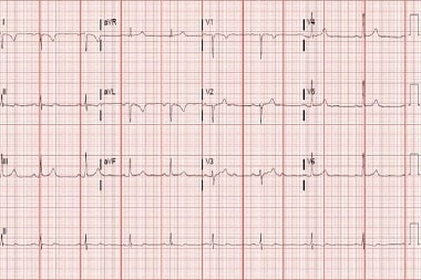 A 34-Year-Old Female with a Syncopal Episode but No Remarkable History A 34-Year-Old Female with a Syncopal Episode but No Remarkable History