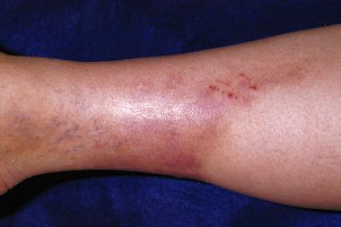 A 46-Year-Old Woman with a Painful, Erythematous Plaque on Her Leg A 46-Year-Old Woman with a Painful, Erythematous Plaque on Her Leg