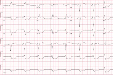 A 70-Year-Old Female with Nonradiating Chest Pain A 70-Year-Old Female with Nonradiating Chest Pain