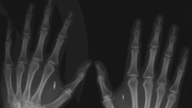Microchip implantado en las manos