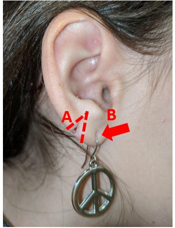 Repair Of Split Earlobe Lacerations In The Urgent Care Journal Of Urgent Care Medicine