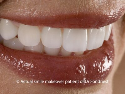 Covering teeth with veneers Veneering Teeth