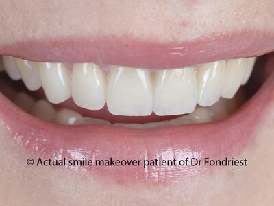 The Veneering Process Porcelain teeth covers