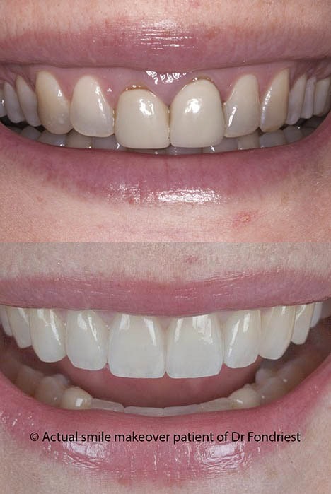 Teeth makeover before and after teeth makeover before and after pictures