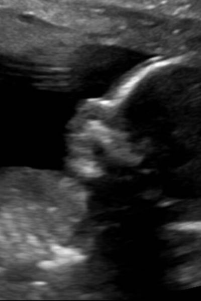 Ultrasound image of a baby in utero