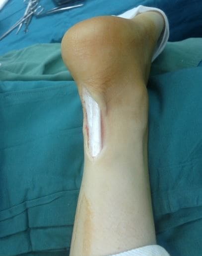 achiles tendon