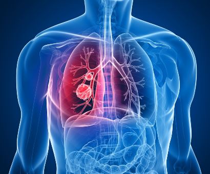 Lung Cancer