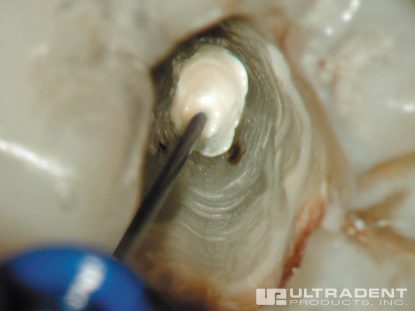 3_NaviTip-Clinical_Apical-Delivery