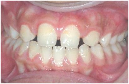 Diastema due missing incisors Diastema due missing incisors