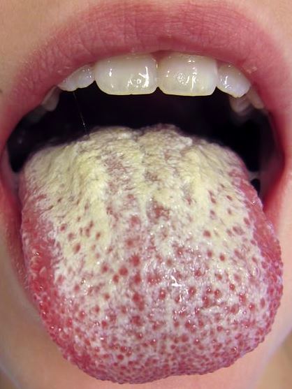 Oral Yeast Infection