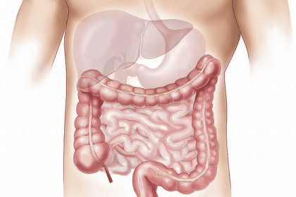 the dietary management of ulcerative colitis
