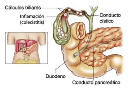 Cirugía de la vesícula biliar en Córdoba