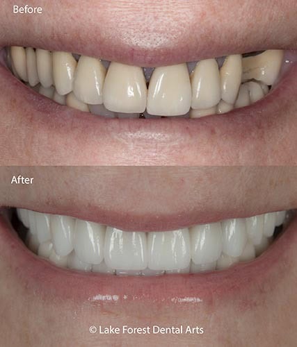 smile makeover with tooth crowns best dental crowns