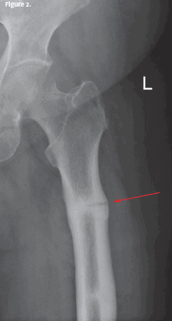Clinical Challenges: Hip/femur x-ray Image with arrow pointing to fracture in femur