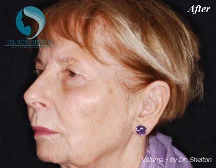 a-2 After Volluma to Cheekbones
