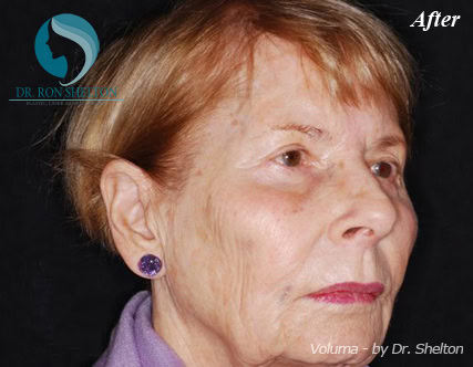 a-3 After Voluma to Cheekbones