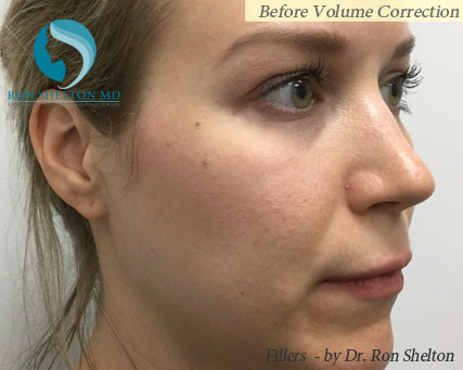before-fillers-right-ob Before Fillers