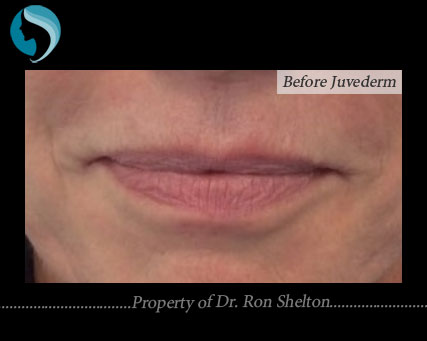 before-juvederm-duck-lips Duck Lips Before Juvederm