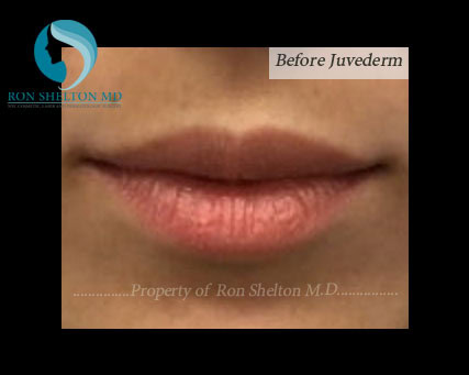 before-volbella-juvederm Before Juvederm