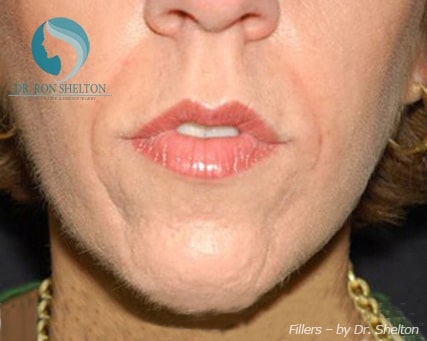 fillers-3 Before Fillers